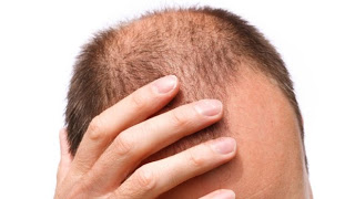 Minoxidil 5% Foligain N5 срещу косопад и оплешивяване за мъже  на изгодна цена е за локално приложение  и се използва за стимулиране растежа на косата при хора, които оплешивяват.