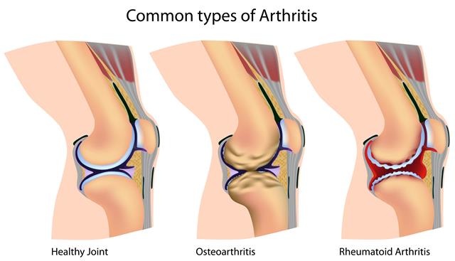 Най-често срещаната форма на артрит е т.нар. остеоартрит -  засягаща  най-вече ръцете, гърба, краката, бедрата и коленете.