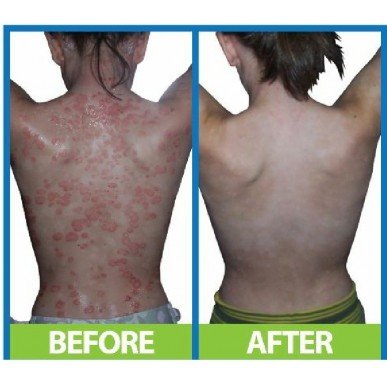 ДермаСпрей Интензив (DermaSpray Intensive) 100/250 мл