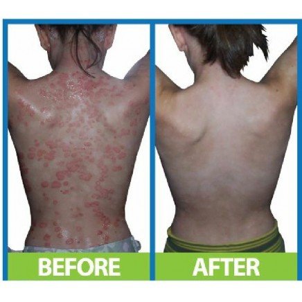 SAL-033045 - Dermaspray Intensive 100 ml в категория Псориазис.