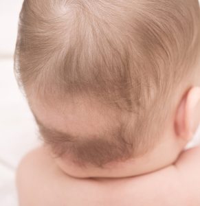 Признаци на рахит при бебетата е падането на косата на тила, повишеният плач, прекаленото потене, нарушения в съня