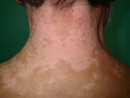 Вилитиго са депигментирани петна по кожата, които могат да се появят навсякъде по тялото и да се разрастват и преливат