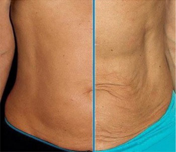 Body Butter на Olivolio има подмладяващо действие и премахва бръчките