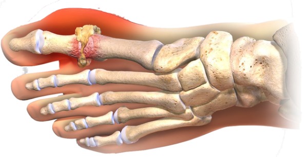 Osteo Gout Pain Relief with InflamEase на хит цена намалява възпалението и облекчава болката при подагра