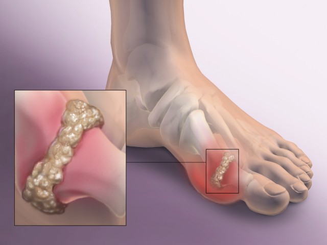 Osteo Gout Pain Relief with InflamEase от Webber Naturals се бори със симптомите и прогресирането на подагра
